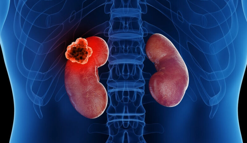 Robot-assisted Partial Nephrectomy for Hilar and Nonhilar Renal Masses