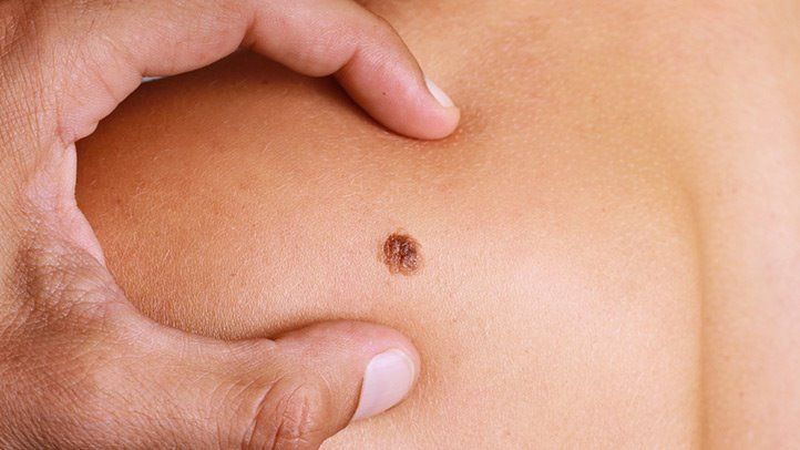 Overcoming Stage IV Melanoma with Innovative Treatment and Expert Care – SCRI