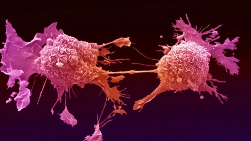 Cancer Research UK – Zombie cell hunting: A world-first urine test for lung cancer