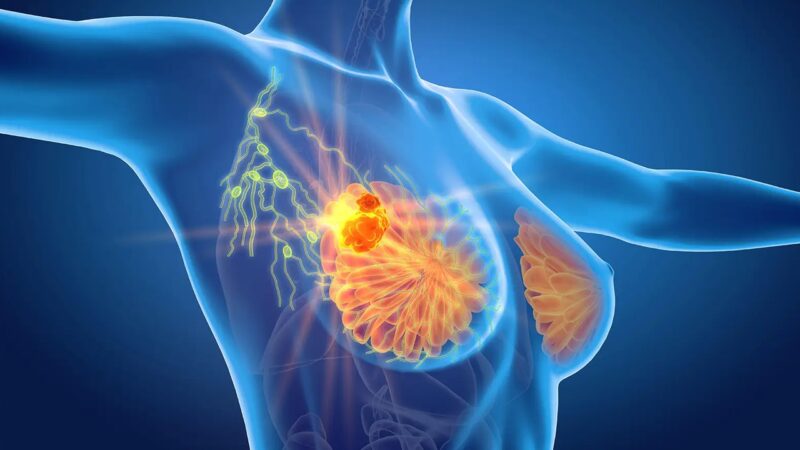 Adjuvant Atezolizumab for Early Triple-Negative Breast Cancer