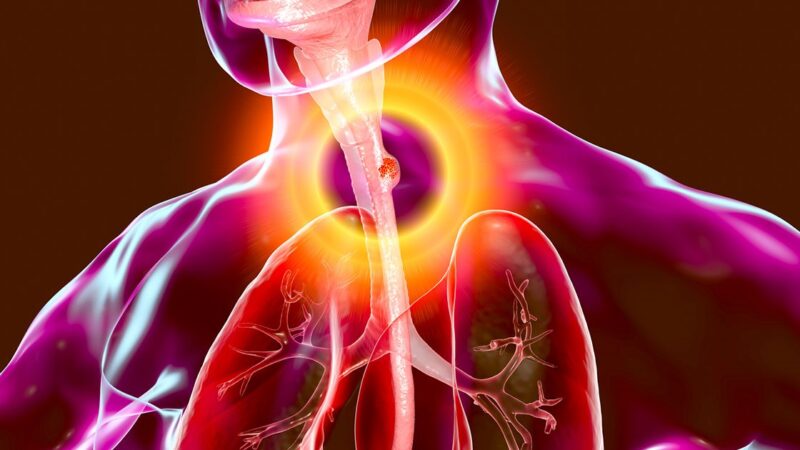 Compliance to Multimodality Treatment for Oesophageal Cancer in India – IASO-IJSO