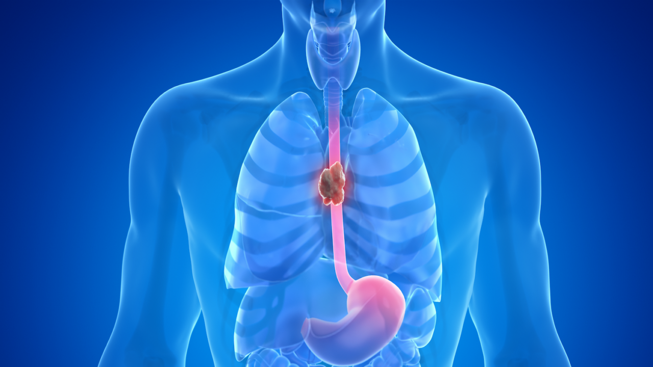 Erman Akkus: German guideline for esophageal SCC and adenocarcinoma