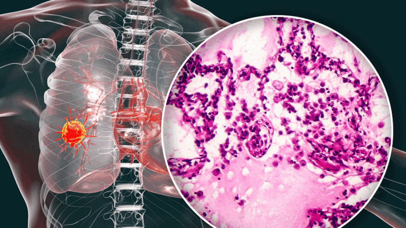 Glecirasib in KRASG12C-mutated non-small cell lung cancer by Yuankai Shi et al