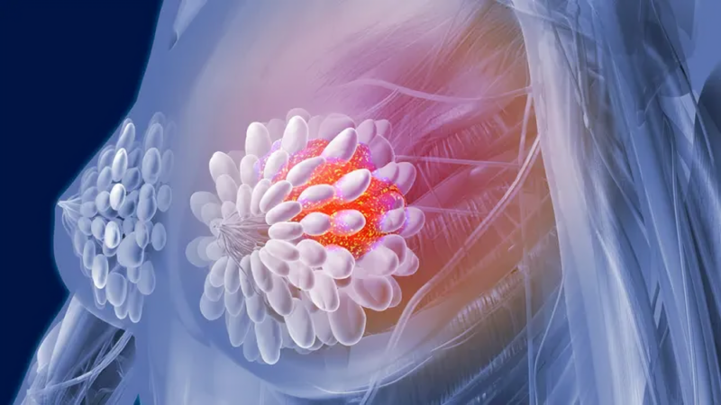 Aleix Prat: The Katherine phase III updated results are out