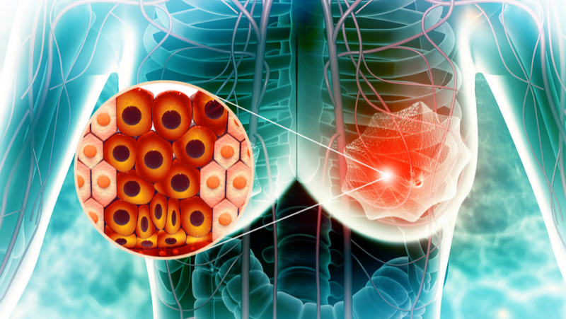 TNBC modifies the systemic immune landscape and alters neutrophil functionality