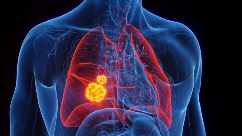 “Without coordinated global action, lung cancer deaths are estimated to increase by a 30% until 2030” – Cary Adams