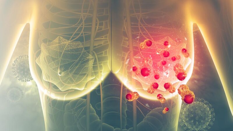 Pembrolizumab and chemotherapy in high-risk, early-stage, ER+/HER2− breast cancer