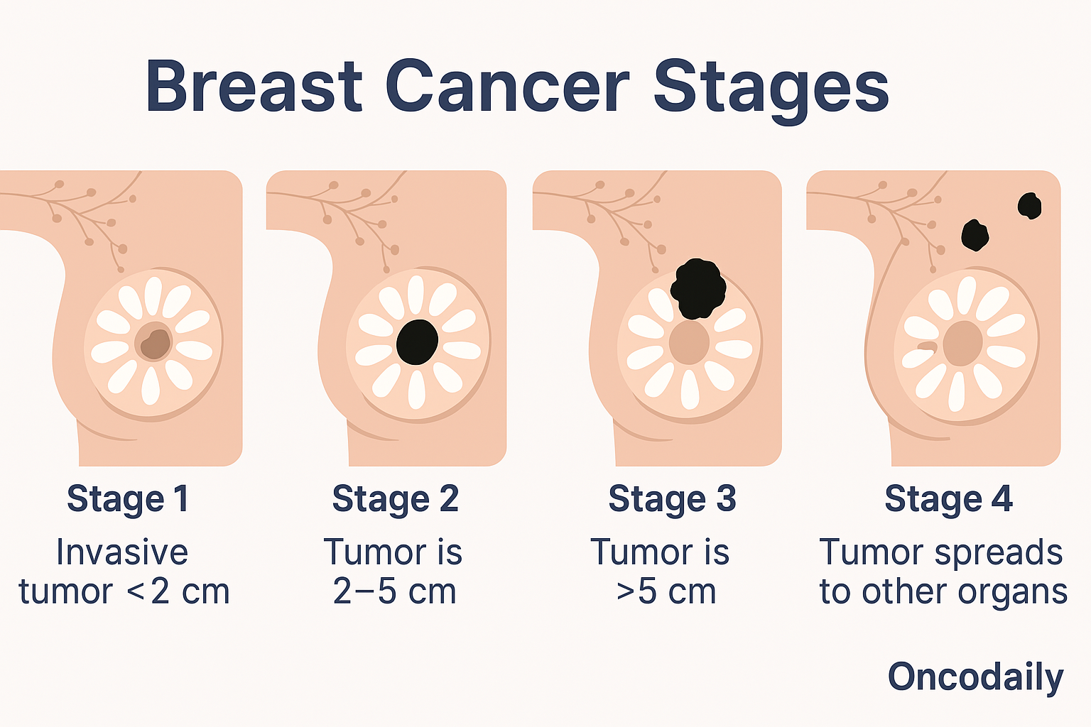 Breast Cancer Stages