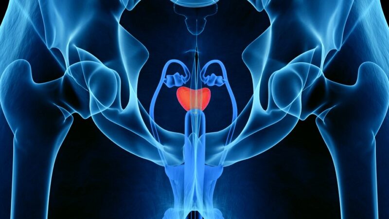 Elai Davicioni: Predicting Dose-Response to Prostate Cancer Radiotherapy