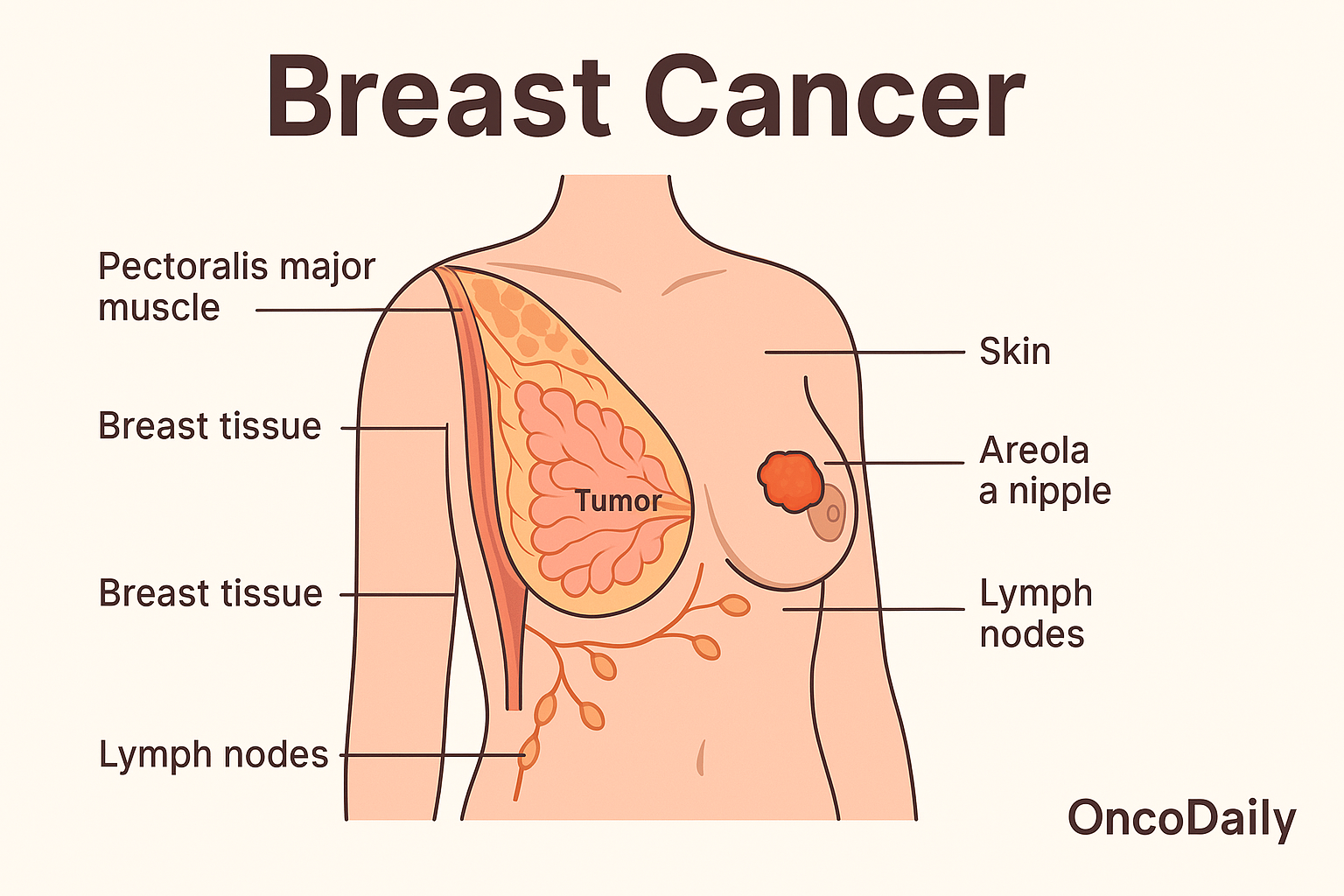 breast cancer what is