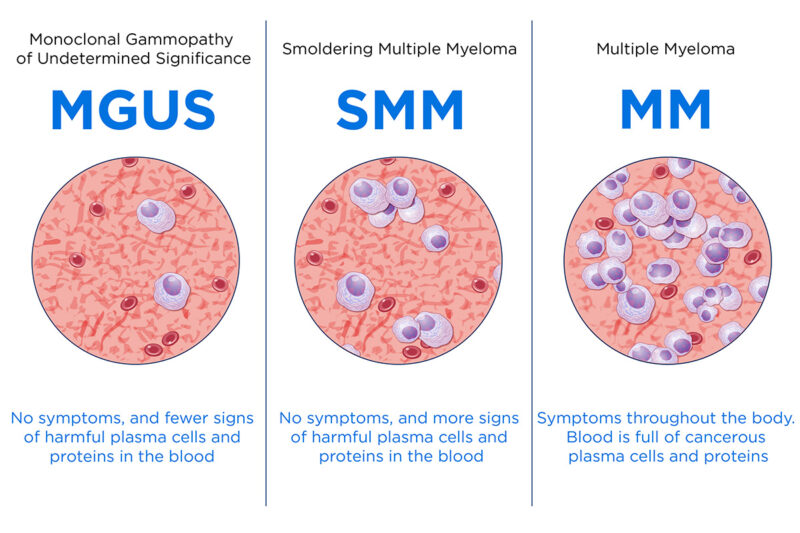 Types of Multiple Myeloma