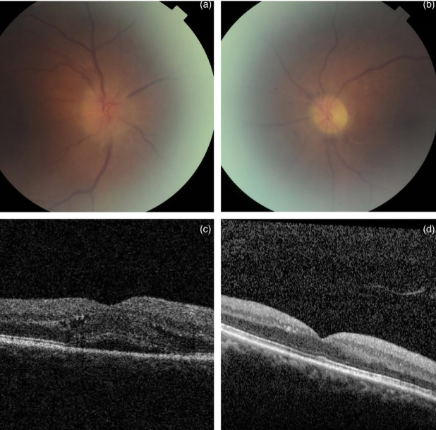 Chemotherapy and ocular side effects