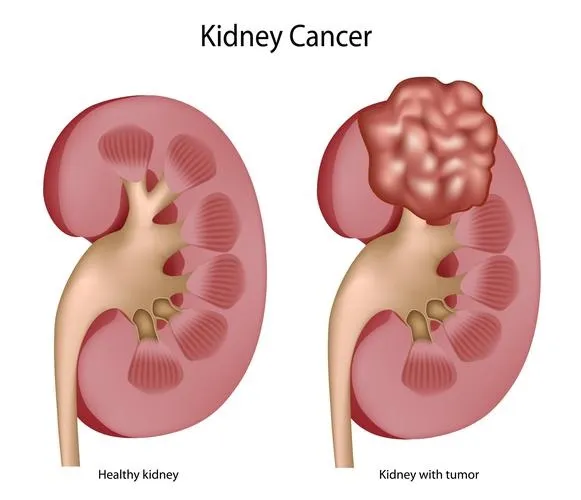 Kidney cancer