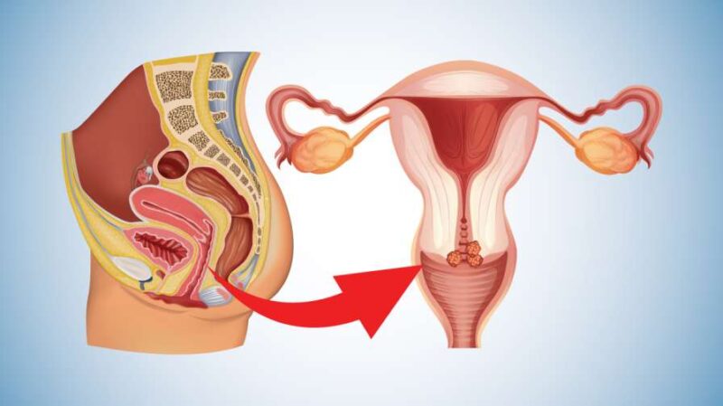 Cervical Cancer