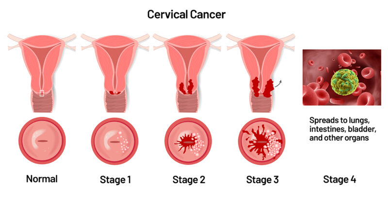 stage of cervical cancer