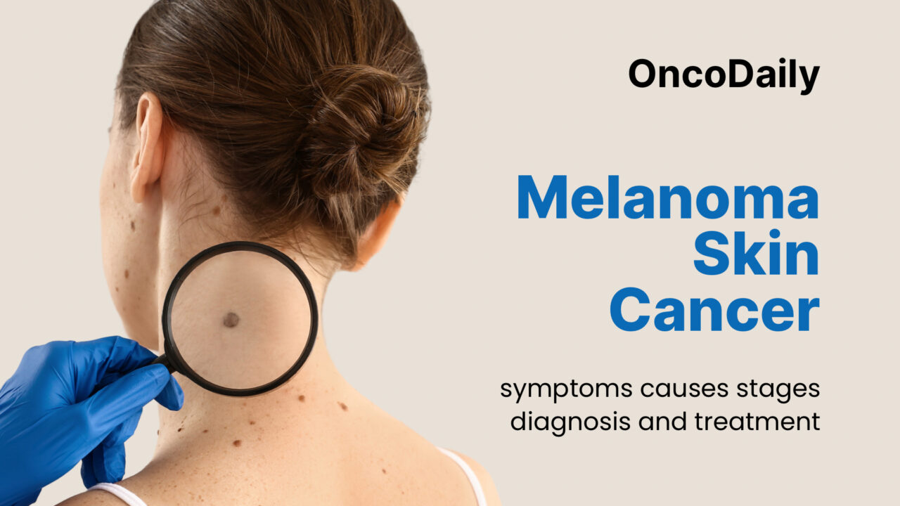 Melanoma (Skin Cancer): Symptoms, Causes, Stages, Diagnosis and Treatment