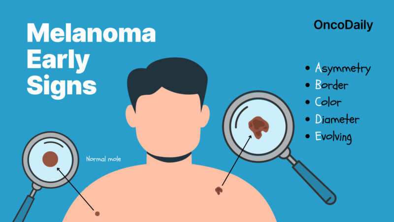 Melanoma signs OncoDaily