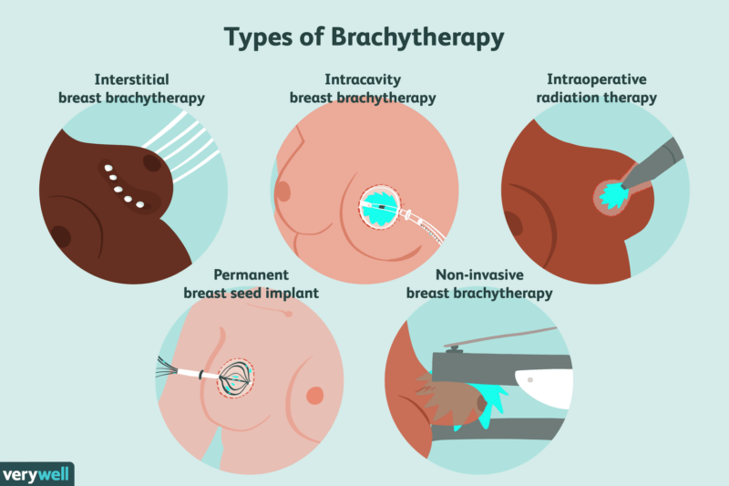 brachytherapy