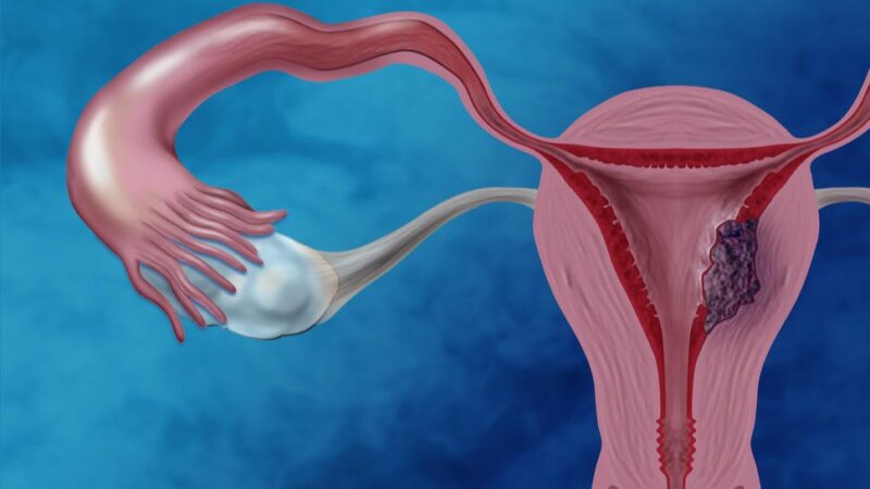 Efficacy of PD-L1 inhibition in the treatment of endometrial cancer across molecular classes