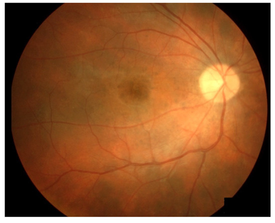 Ocular Side Effects Of Immune Checkpoint Inhibitors