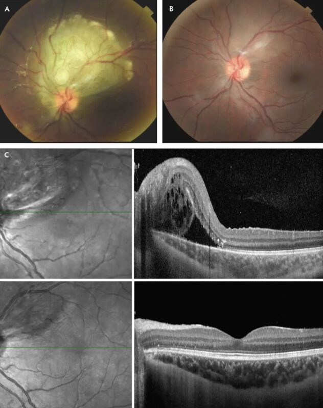 Ocular Side Effects of Anti-VEGF Therapy