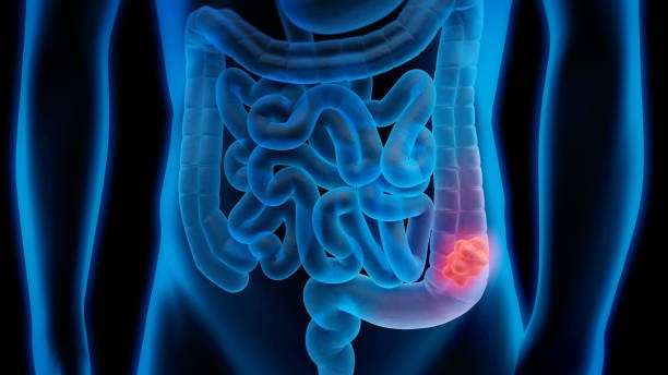 Caryn Lerman: Heinz Josef Lenz delves into the early symptoms of colorectal cancer