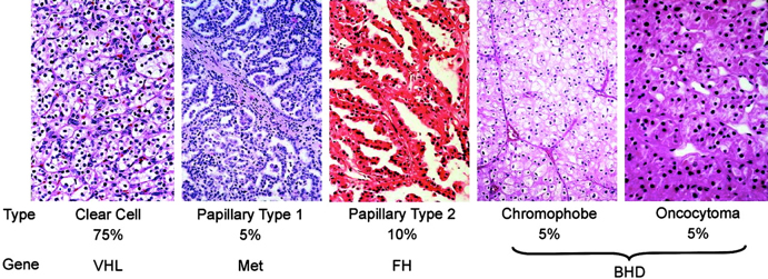 Types of Kidney Cancer