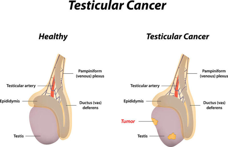 Testicular cancer