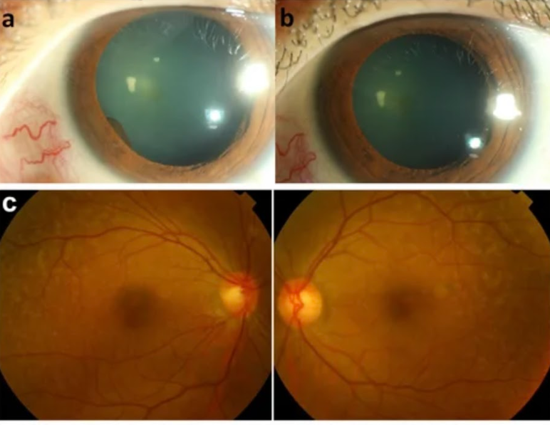 ocular side effects of immune checkpoint inhibitors