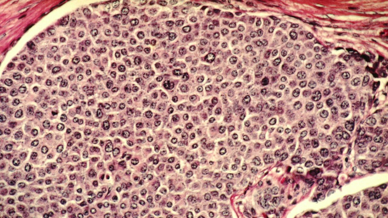 Study links prolactin levels to breast cancer risk in post-menopausal women – ICR
