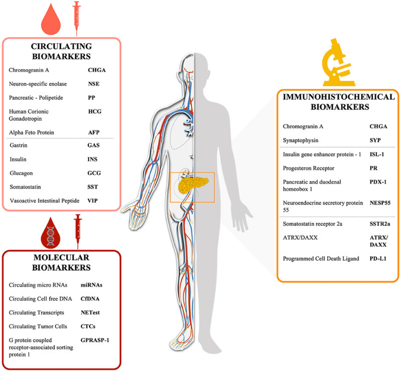 Pancreatic-neuroendocrine-tumors