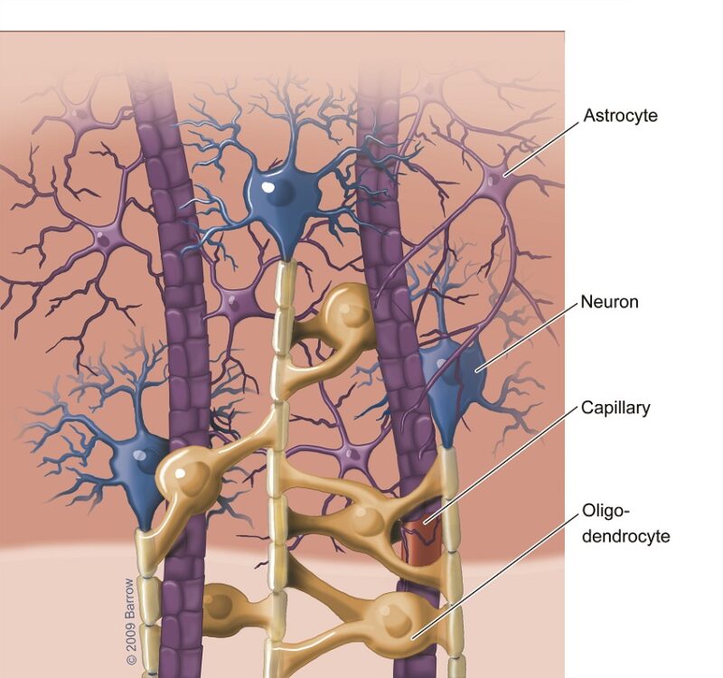 astrocytoma