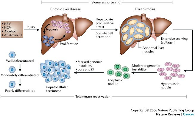 hepatocelular carcinoma patogenesis
