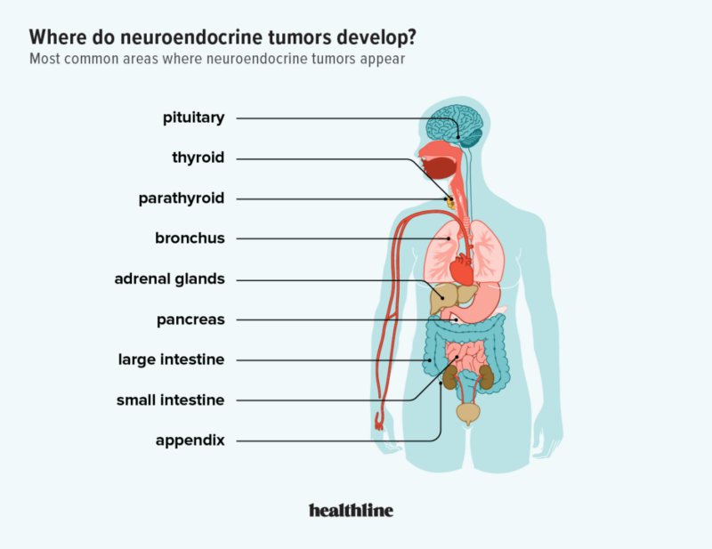 Neuroendocrin-tumors