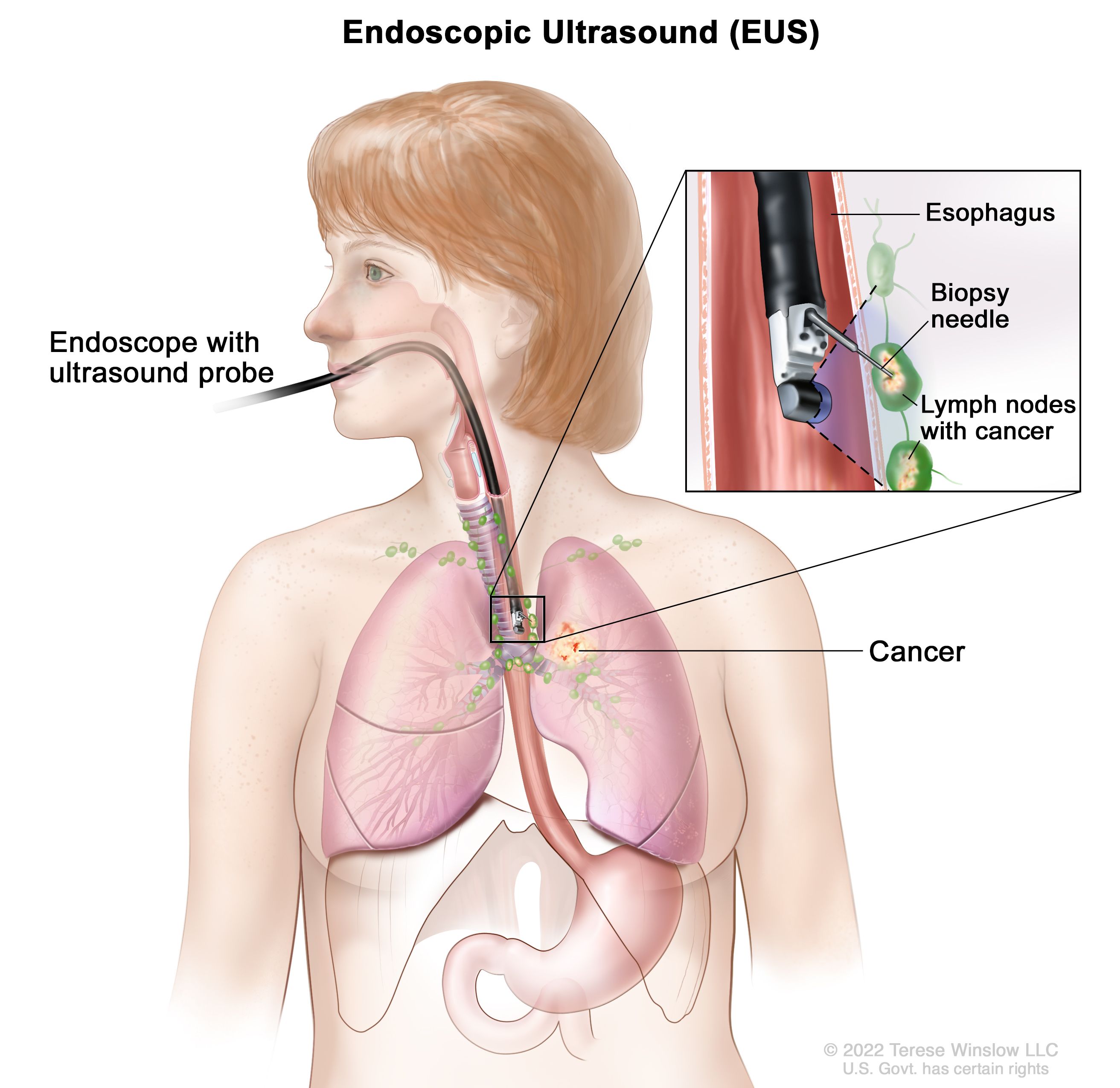 Endoscopic ultrasound