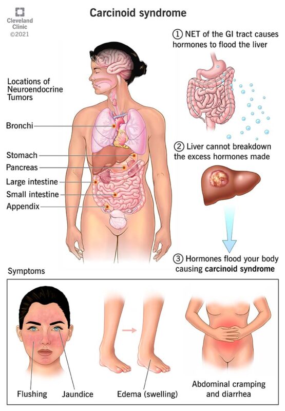 Neuroendocrin-tumors