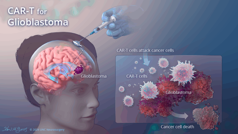 glioblastoma