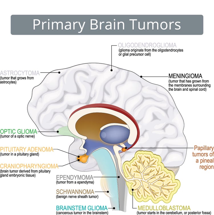 brain-cancer