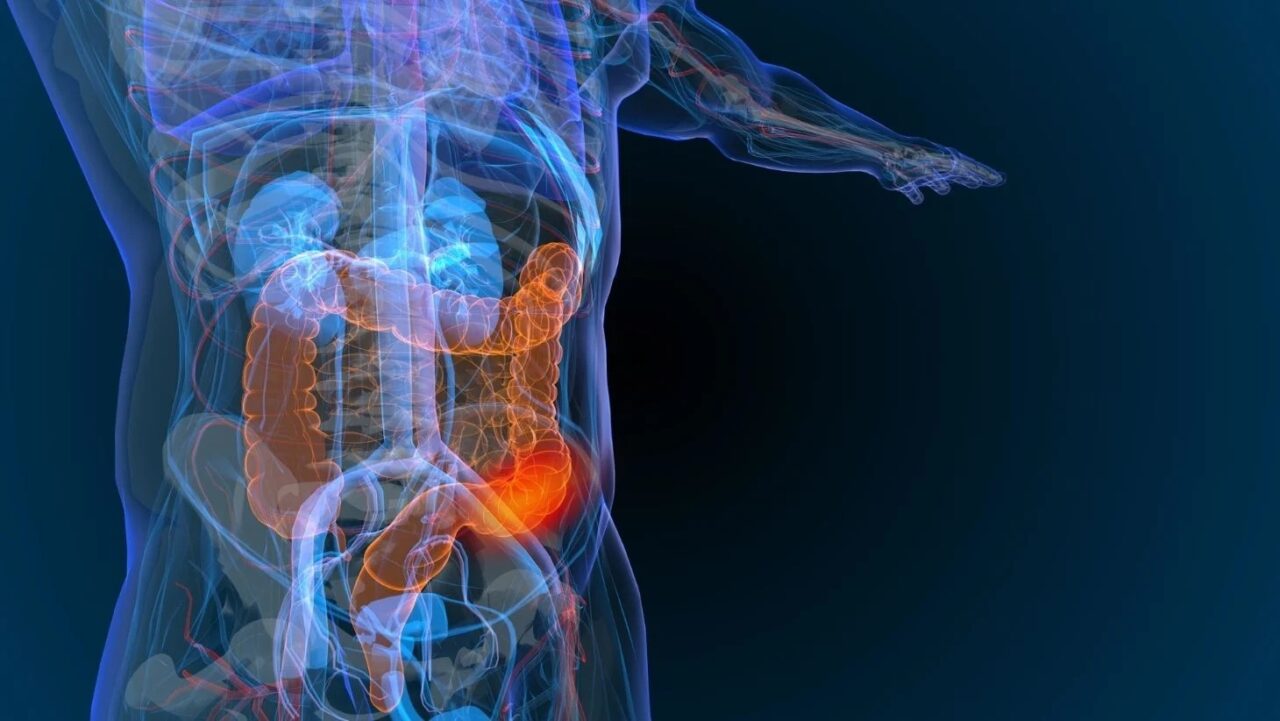 NCCN updates guidelines, favoring DPYD testing for colon, anal, rectal, and small bowel cancers – Precision Medicine