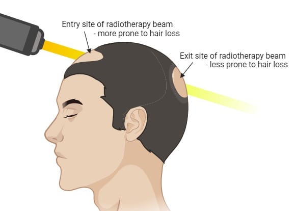 rr_hair_loss