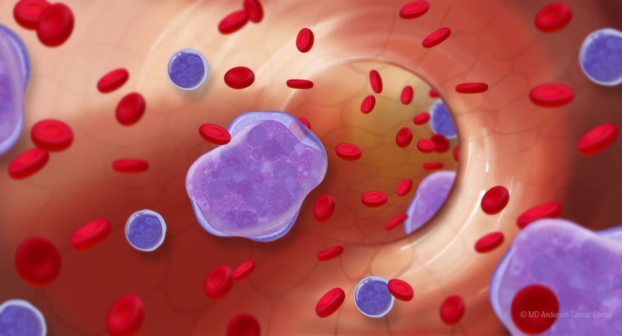 Joshua Brody Highlights Consensus Statement on Richter Syndrome in Blood Journal