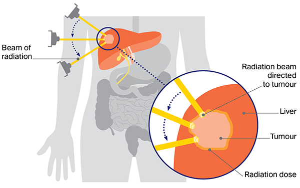 Stereotactic radiotherapy