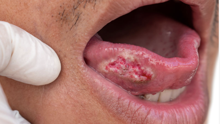 Understanding HPV’s Role in Survival Outcomes and Clinical Impact in Oral cancer – IASO-IJSO online