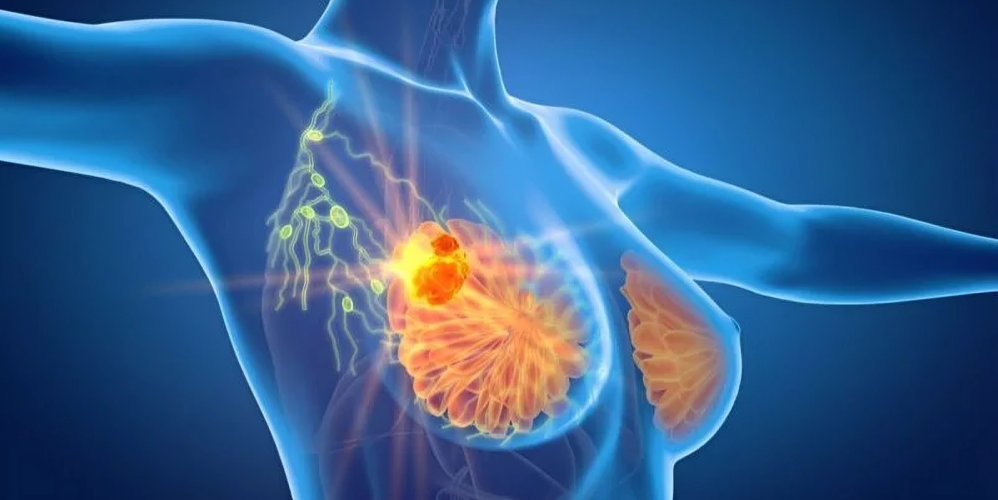 Breast Cancer 