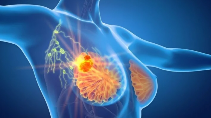 ABC Global Alliance and EUSOMA Collaborate on New Quality Indicators for Metastatic Breast Cancer Care