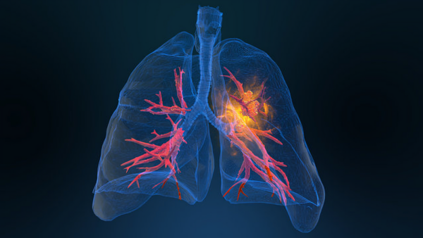 Low-dose CT Scans Identify 80% of Early Lung Cancers in High-Risk Groups – Lung Cancer Europe