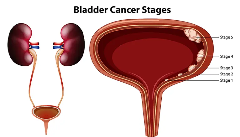 Durvalumab FDA approval 