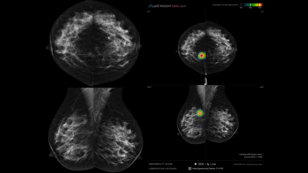 Sahar Mansour: First prospective study in Egypt to evaluate AI in double reading for breast cancer screening