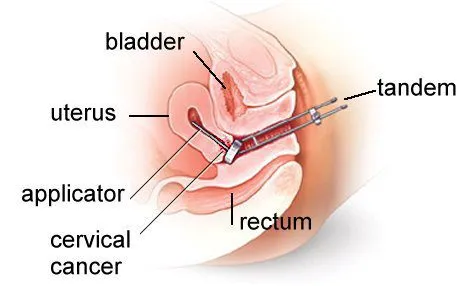 brachytherapy for cervical cancer