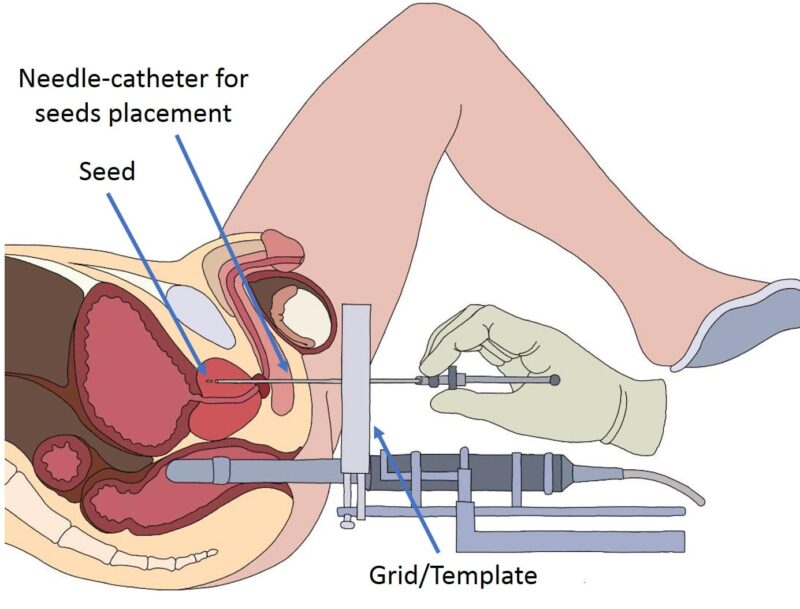 brachytherapy